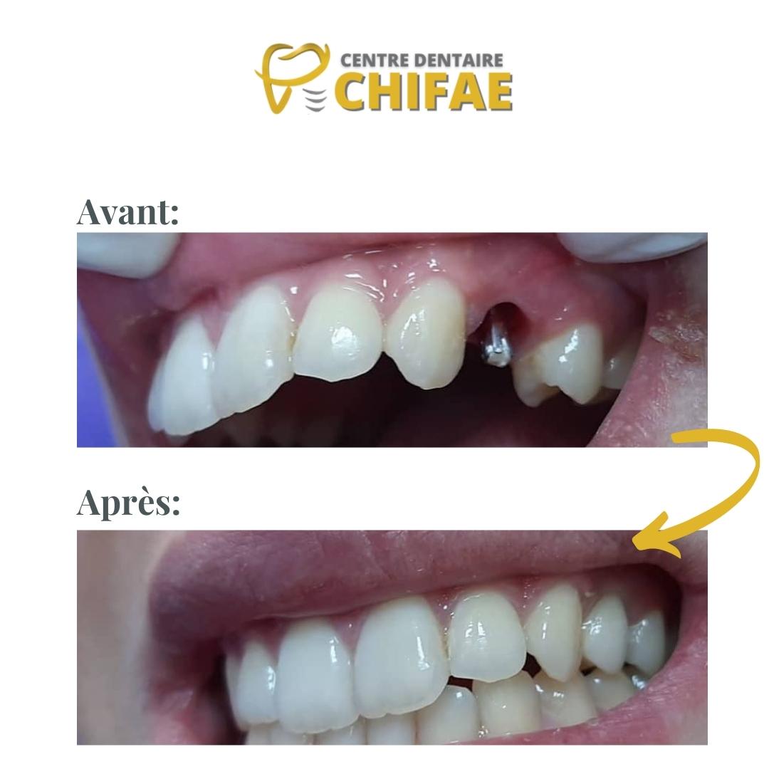 1 implant dentaire Tanger