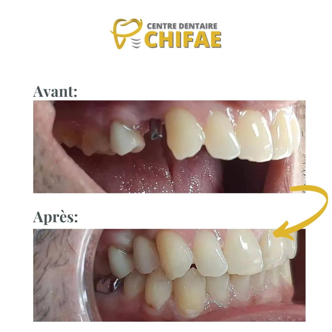 3 implant dentaire Tanger