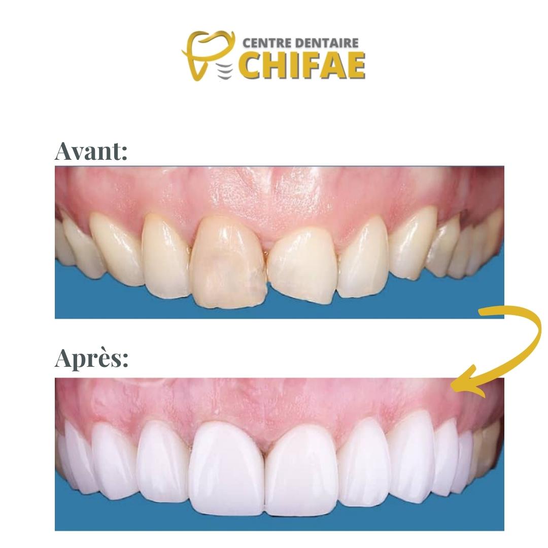 4 blanchiment dentaire Tanger